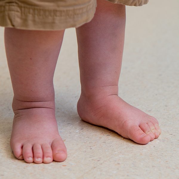 صافی کف پا در کودکان